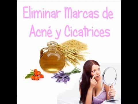 Cómo hacer aceite para eliminar manchas de acné y cicatrices